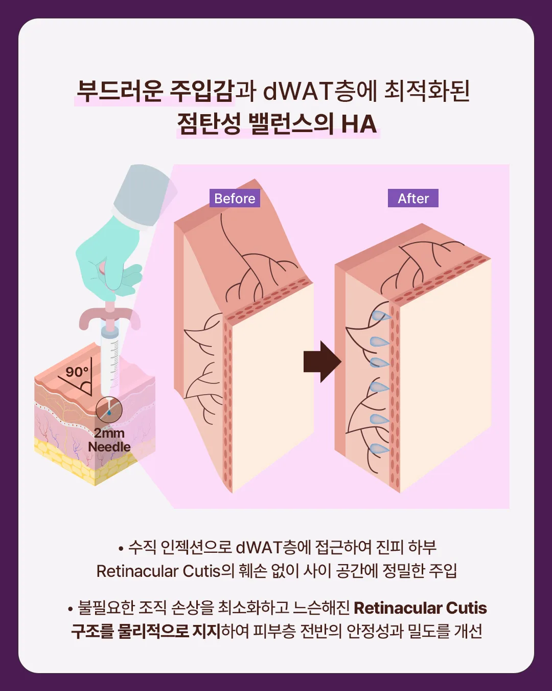 다미온의원 하이로라 — dWAT층 주입 원리